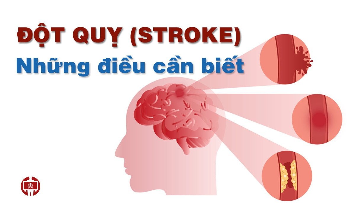 điều cần biết về đột quỵ